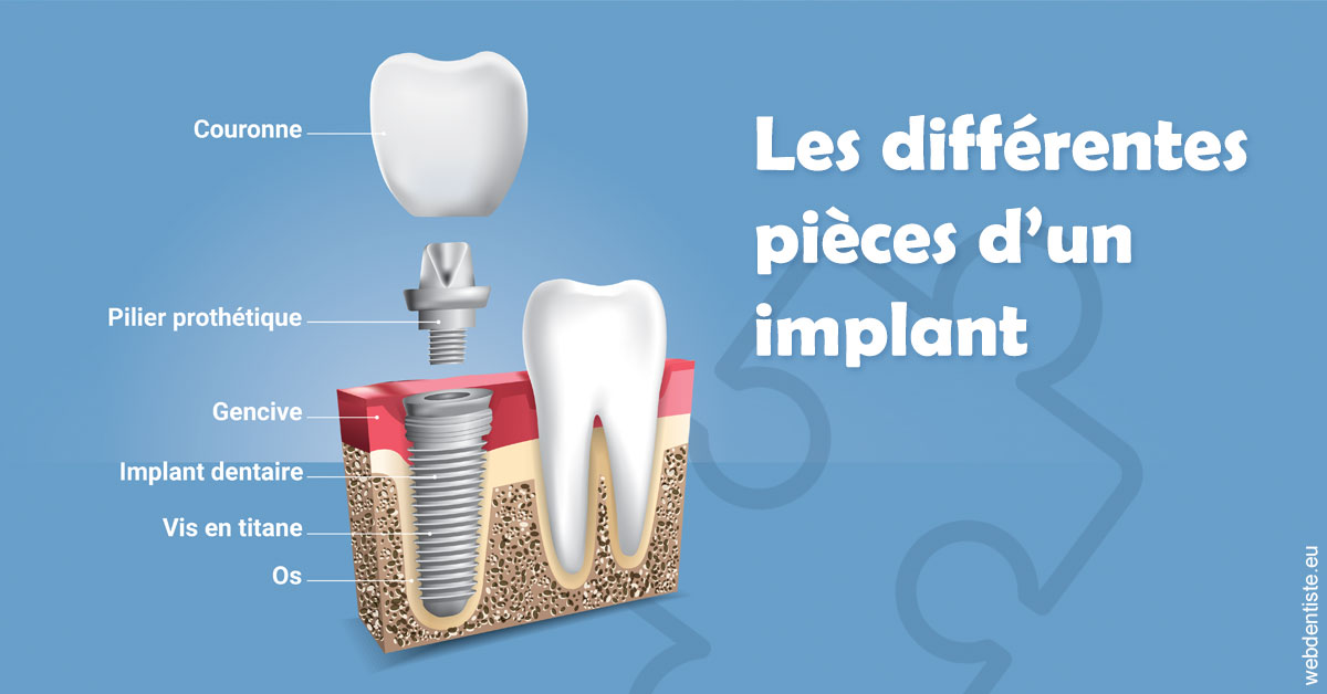 https://dent1ste.fr/Les différentes pièces d’un implant 1
